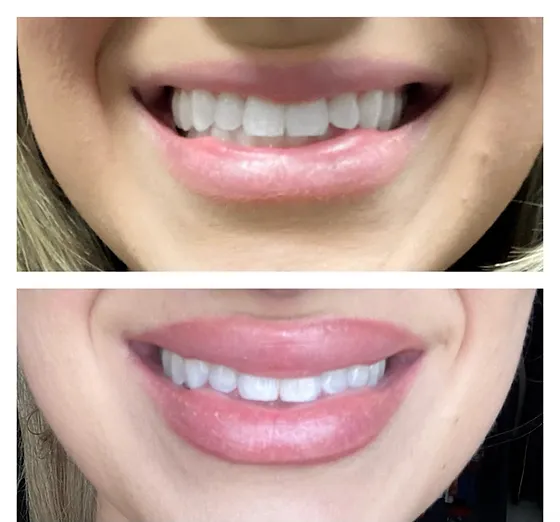How Long Does Botox Lip Flip Last? Understanding Results and Maintenance
